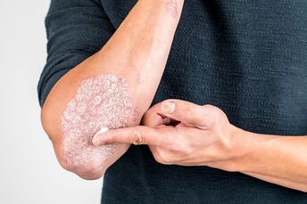 Aplicar la crema en la zona de la piel dañada por la psoriasis. 