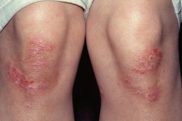 psoriasis en las rodillas