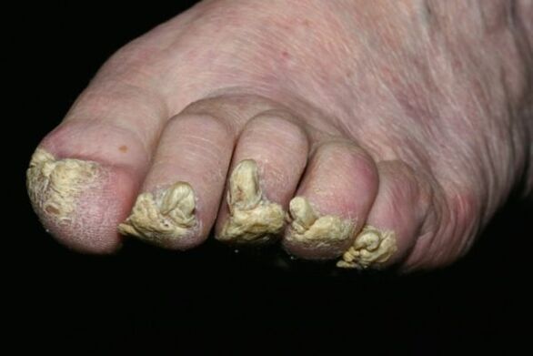 psoriasis en las uñas de los pies