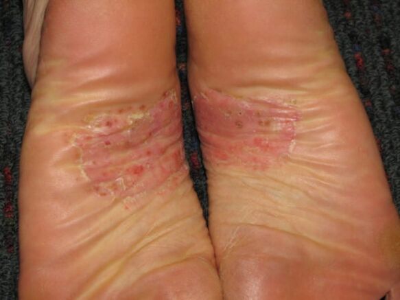 psoriasis en los pies
