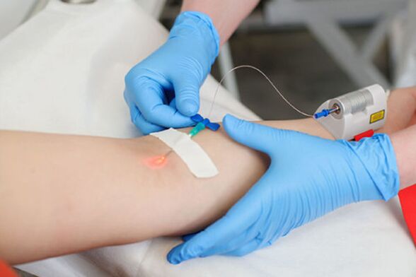 tratamiento con láser intravenoso para la psoriasis en las piernas