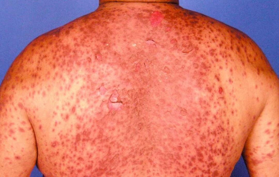 eritrodermia psoriásica en la espalda