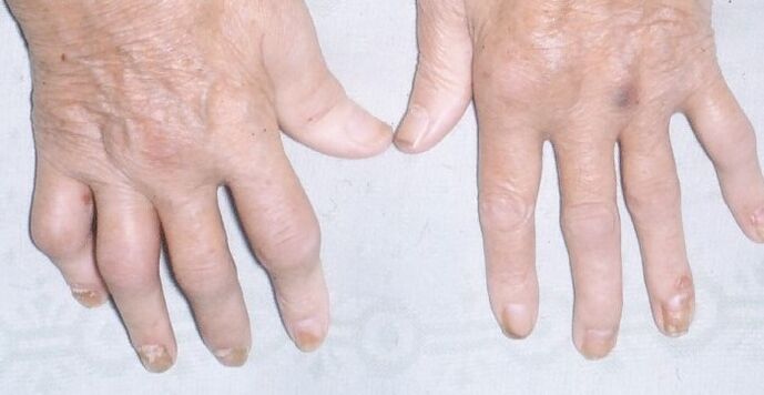 psoriasis artropática en las manos