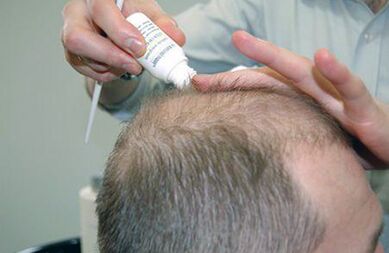 tratamiento de la psoriasis del cuero cabelludo