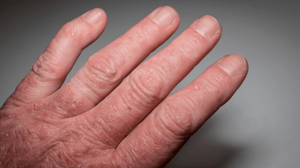 artritis psoriásica en las manos