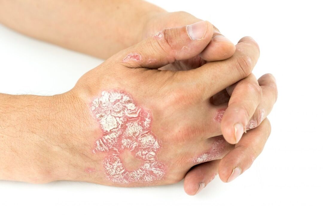 ¿Cómo se ve la psoriasis en las manos 
