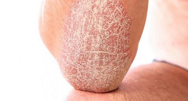 psoriasis vulgar en la piel