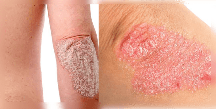 ¿Cómo se ve la psoriasis en la piel 