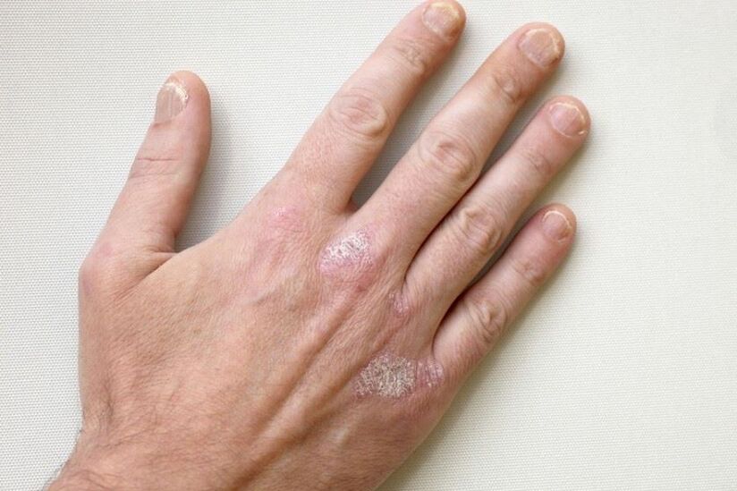 Un síntoma obligatorio de la psoriasis son las placas con escamas en la piel. 