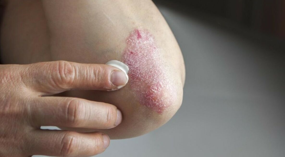 Psoriasis que afecta a la piel, cuyo tratamiento incluye el uso de ungüentos. 