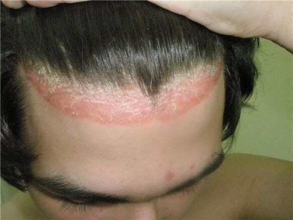 Manifestaciones de psoriasis del cuero cabelludo. 
