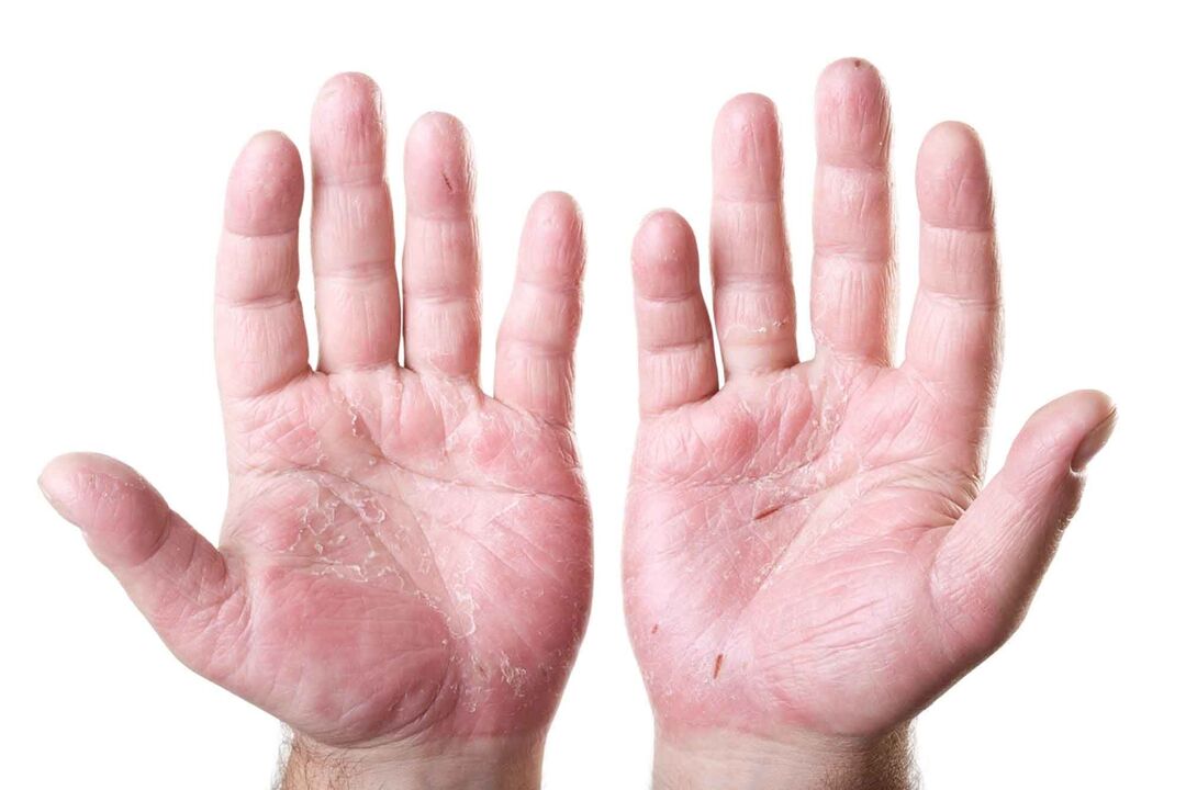 tipos de psoriasis en las palmas