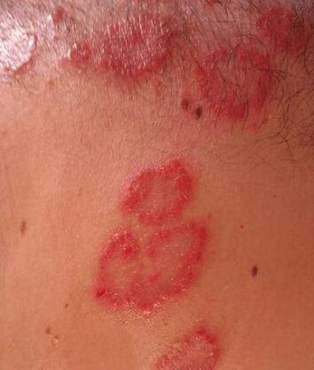 Manchas de psoriasis