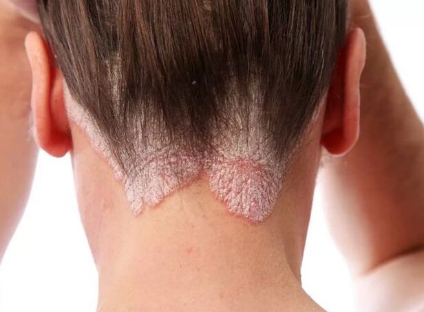 Eritroderma psoriásica