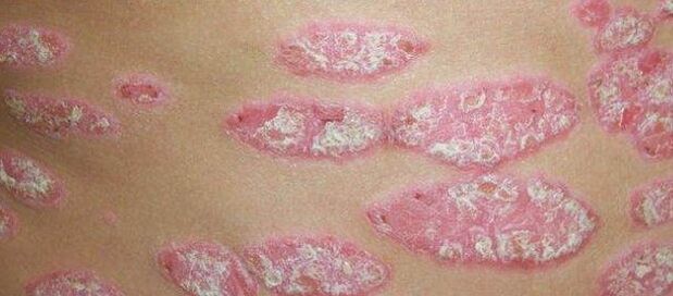 La etapa progresiva de la psoriasis