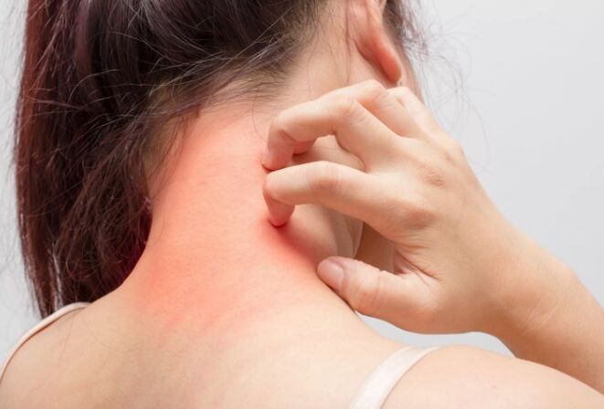 La picazón es una de las causas de la psoriasis