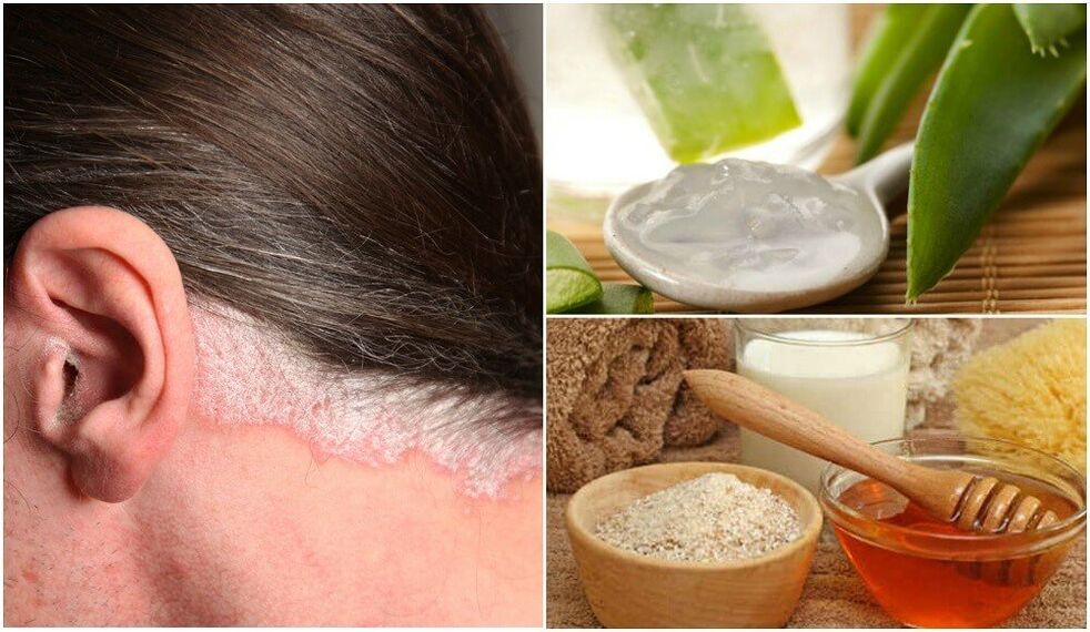 Tratamiento de la psoriasis con remedios populares