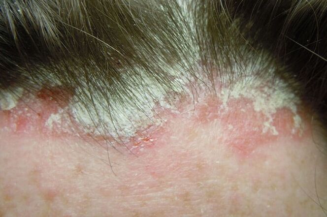 La psoriasis captura toda la parte peluda de la cabeza