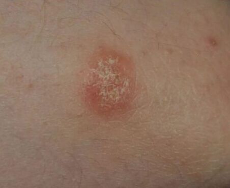 Lugar de psoriasis