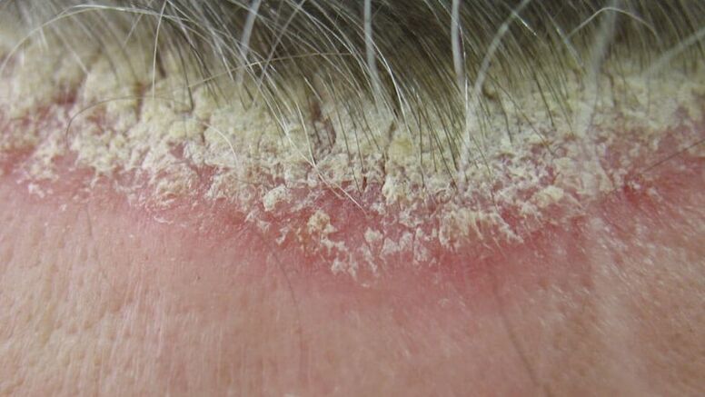 Psoriasis del cuero cabelludo