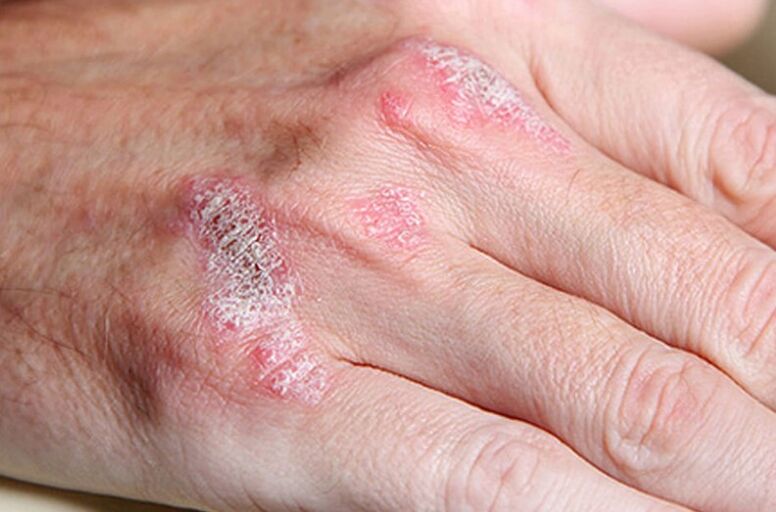 Psoriasis sostenida por Ladomary