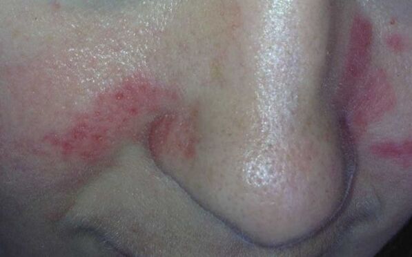 Síntomas de la psoriasis en la cara