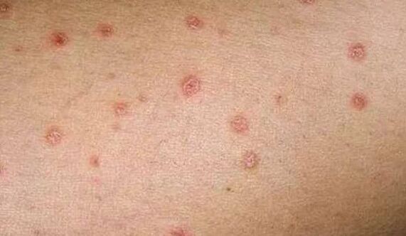 La etapa inicial de la psoriasis