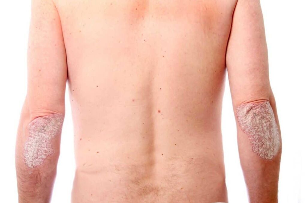 La segunda etapa de la psoriasis