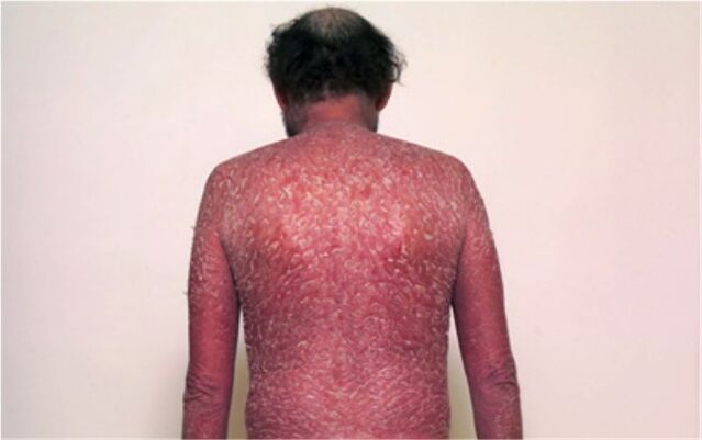La tercera etapa de la psoriasis