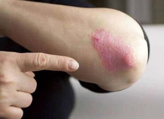 La etapa estacionario de la psoriasis
