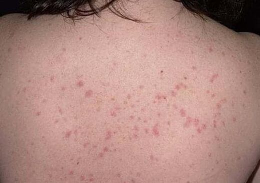 La etapa inicial de la psoriasis