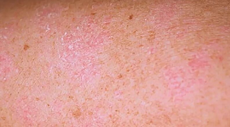 La etapa regresiva de la psoriasis