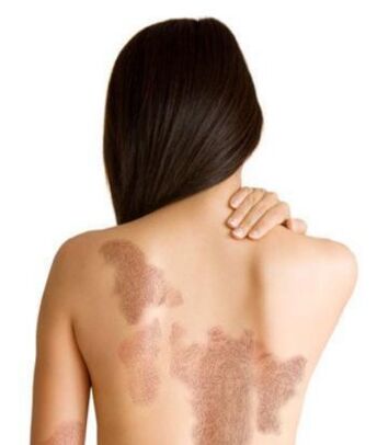Etapas de la psoriasis dependiendo del área de la lesión