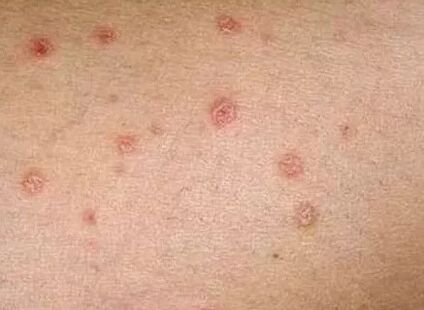 Psoriasis de la etapa inicial