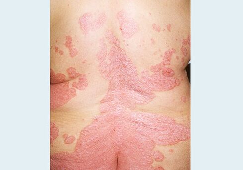 Psoriasis de la espalda