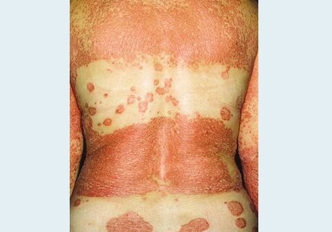 Psoriasis genital