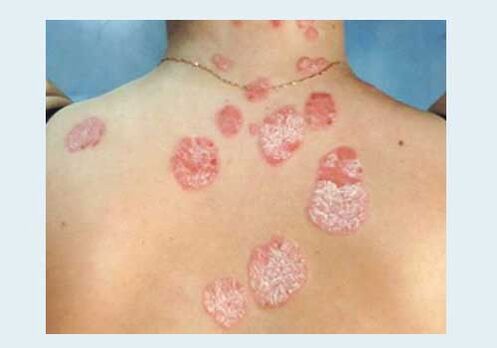 Psoriasis ordinaria