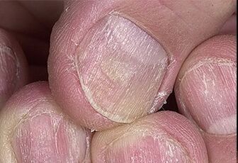 Psoriasis de uñas