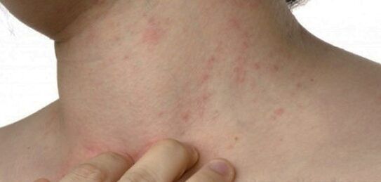 Psoriasis en el cuello