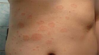 Psoriasis en el estómago