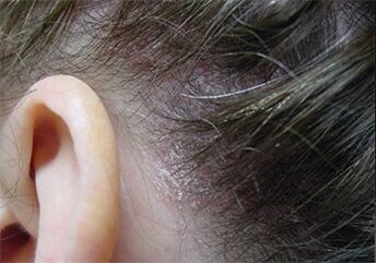 Psoriasis en la cabeza
