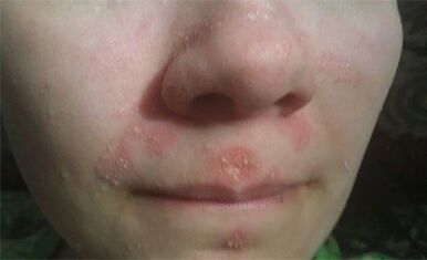 Psoriasis en la cara