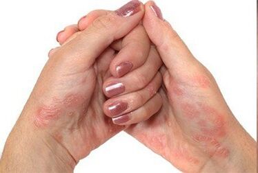 Psoriasis en las manos
