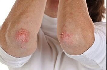 Psoriasis en los codos