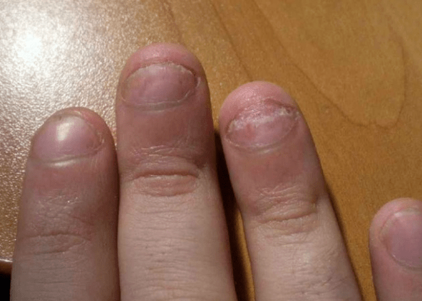 Psoriasis de uñas