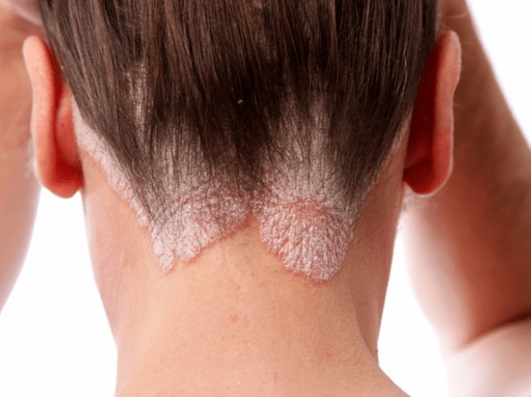 Psoriasis en la cabeza