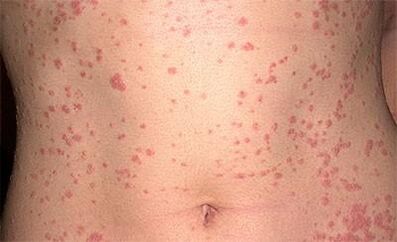 Psoriasis en el cuerpo
