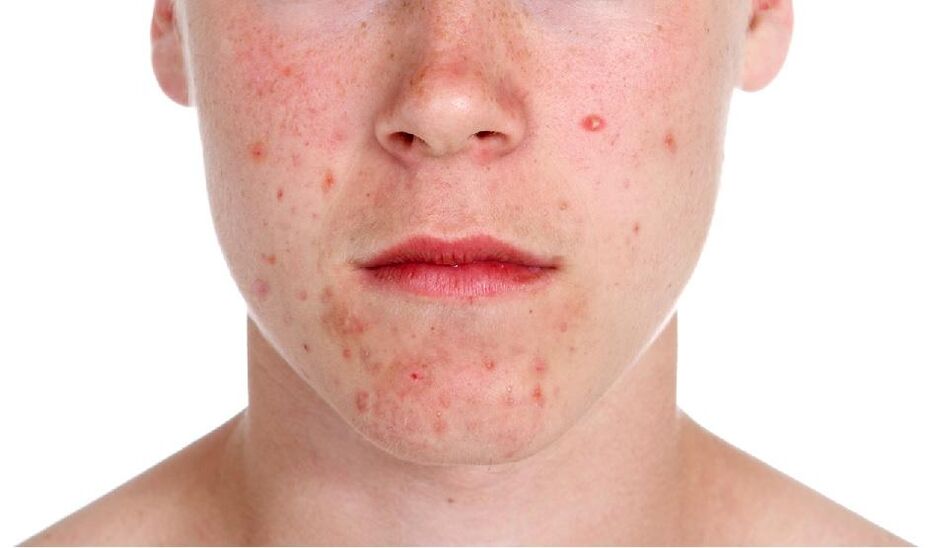 Psoriasis en la cara