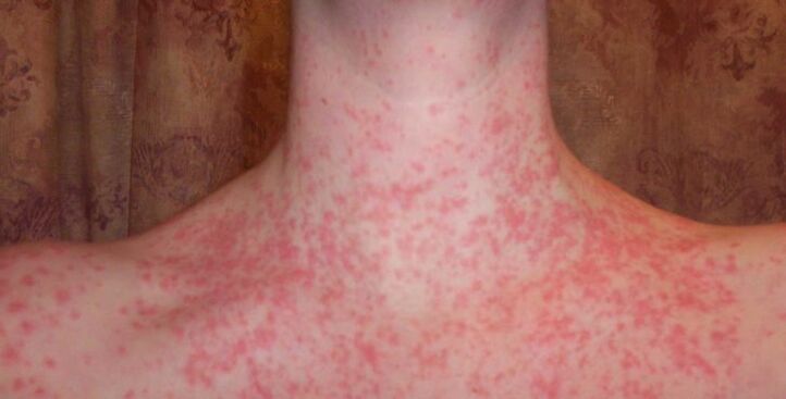 Psoriasis en el cuerpo