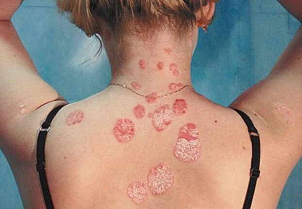 Psoriasis en la espalda